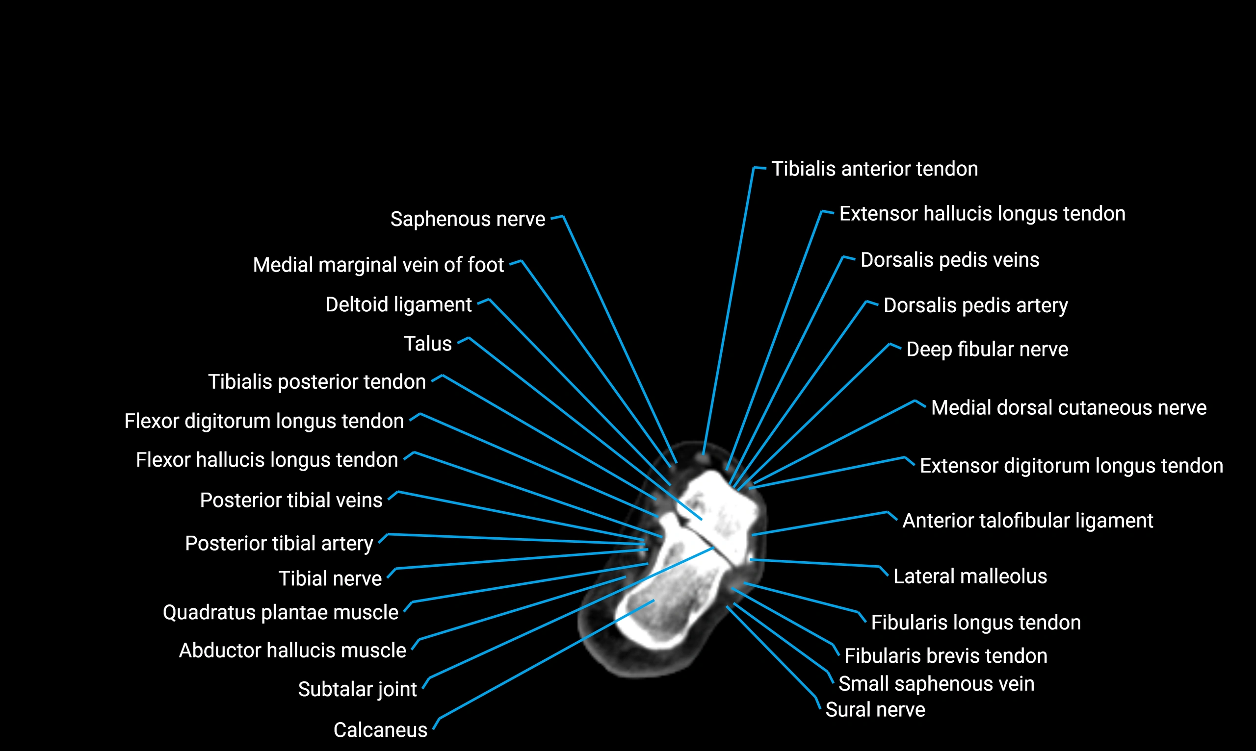CT lower limb axial cross sectional anatomy labelled image 170 (2).webp